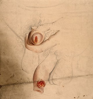 A diseased penis shown from two angles. Watercolour by C. D'Alton, 18--.