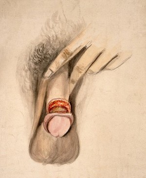 view A diseased penis, showing symptoms of inflammatory or moist gangrene. Watercolour by C. D'Alton, 1857.