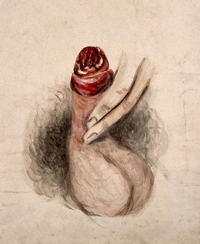 A diseased penis, showing symptoms of inflammatory or moist gangrene. Watercolour by C. D'Alton, 1857.