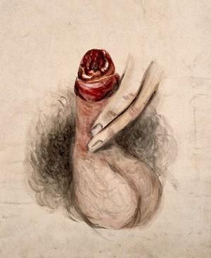 view A diseased penis, showing symptoms of inflammatory or moist gangrene. Watercolour by C. D'Alton, 1857.