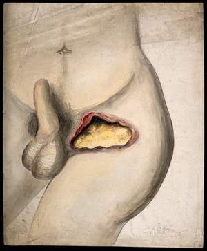 view Severely diseased tissue in the groin area of a man. Watercolour by C. D'Alton, ca. 1853.