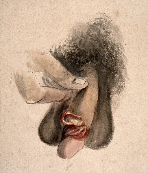 Ulcer on penis, possibly cancerous, 19th C