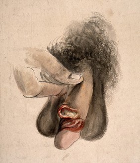 A diseased penis showing symptoms of diptheritic phagedena. Watercolour by C. D'Alton, 18--.