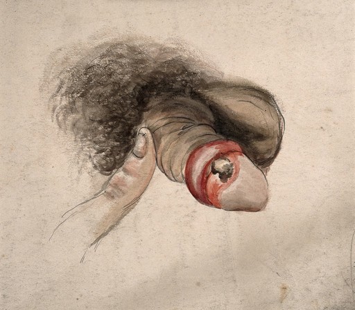 Ulcer on penis, possibly cancerous, 19th C