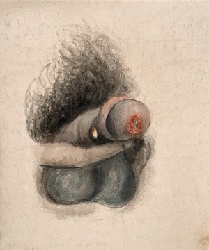 view A diseased penis showing symptoms of "diptheritic phagedena". Watercolour by C. D'Alton, 18--.