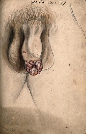 A severely diseased penis. Watercolour by C. D'Alton, 18--.