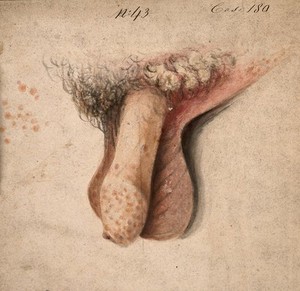 view Diseased penis and scrotum. Watercolour by C. D'Alton, 18--.