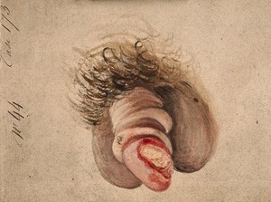 view A diseased penis with decorticating chancre. Watercolour by C. D'Alton, 18--.