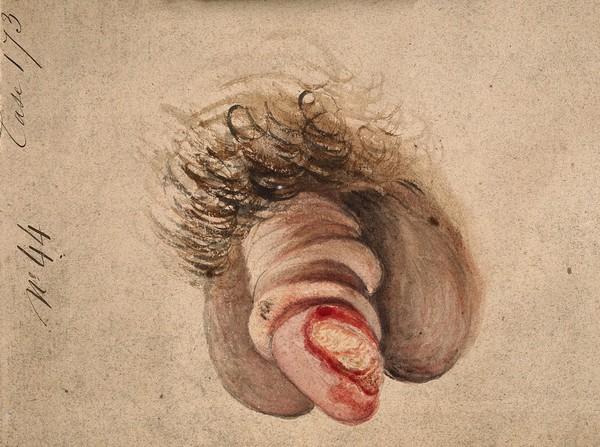 A diseased penis with decorticating chancre. Watercolour by C. D'Alton, 18--.