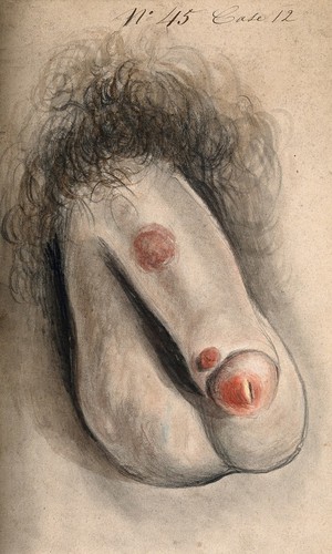 view A diseased penis. Watercolour by C. D'Alton, 18--.
