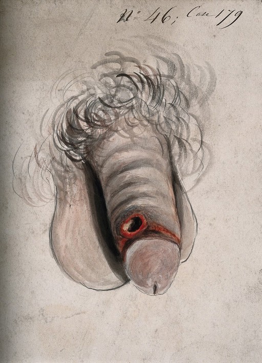 Sores on penis due to poor hygiene, 19th C