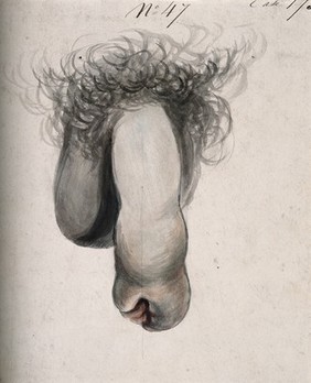 A diseased penis. Watercolour by C. D'Alton, 18--.