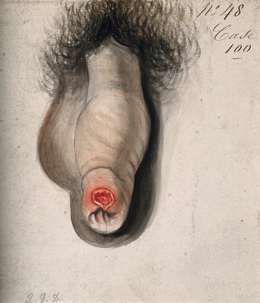 Syphilis; primary sore (chancre) on penis, 19th C