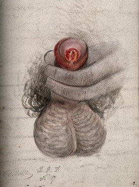 A diseased penis. Watercolour by C. D'Alton, 18--.