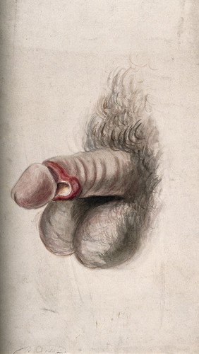 A diseased penis. Watercolour by C. D'Alton, 1856.
