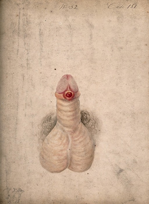 Syphilis; primary sore (chancre) on penis, 19th C