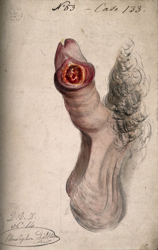 Syphilis; primary sore (chancre) on penis, 19th C