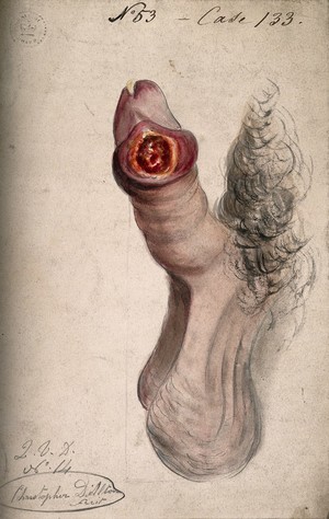 view A diseased penis. Watercolour by C. D'Alton, 18--.