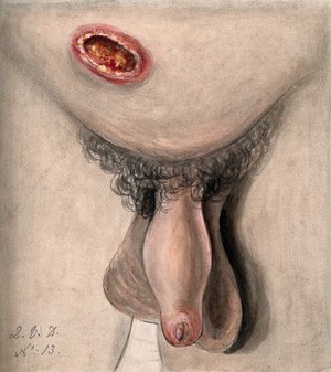 view A diseased penis and lower abdomen showing symptoms of perforating phagedena. Watercolour by C. D'Alton, 18--.