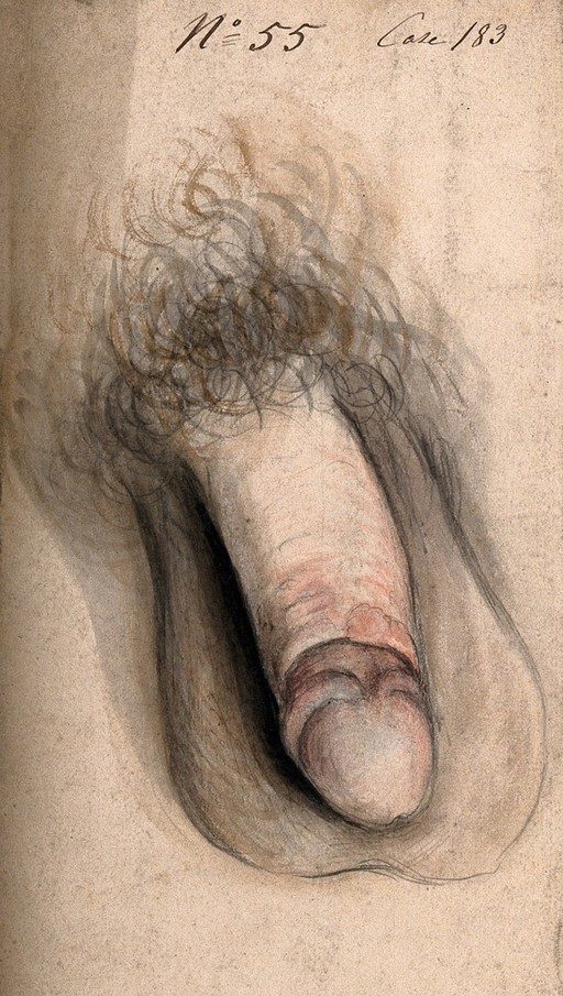 Paraphimosis; penis with retracted foreskin, 19th C