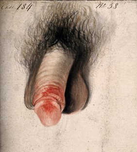 A diseased penis. Watercolour by C. D'Alton, 18--.