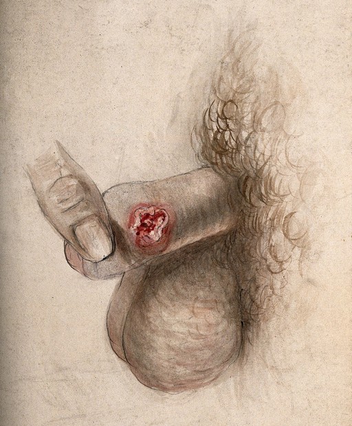 Syphilis; primary sore (chancre) on penis, 19th C