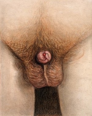 view A diseased penis, showing symptoms of phagedena. Watercolour with chalk, by C. D'Alton, 1865.