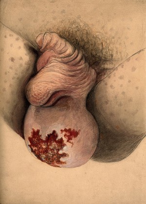 view Severely diseased scrotum with a large growth or tumour. Watercolour with chalk by C. D'Alton, 1866.