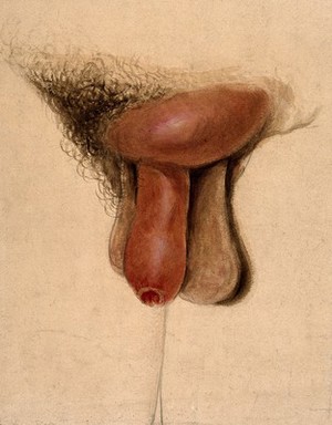 view A diseased penis with a swelling on the pubis. Watercolour by C. D'Alton, 1858.