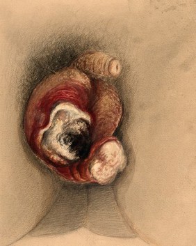 Severely diseased scrotum. Watercolour by C. D'Alton, 1866.