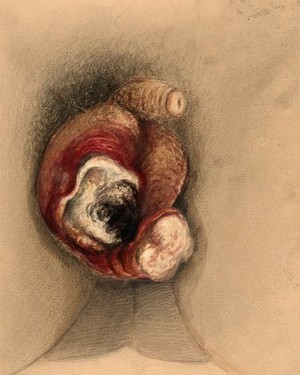 view Severely diseased scrotum. Watercolour by C. D'Alton, 1866.