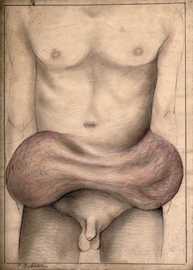 Large, severe swellings on the abdomen of a man. Watercolour with chalk, by C. D'Alton, 1868.
