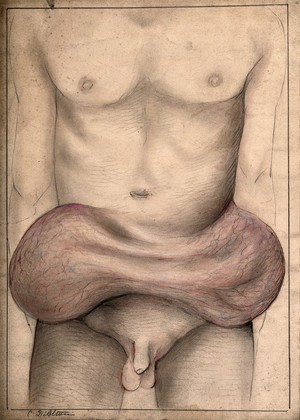 view Large, severe swellings on the abdomen of a man. Watercolour with chalk, by C. D'Alton, 1868.