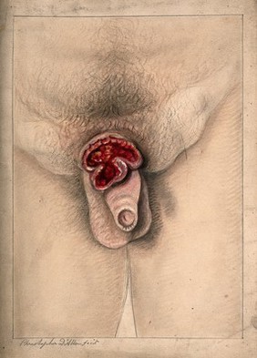 Severely diseased scrotum. Watercolour by C. D'Alton, 1868.