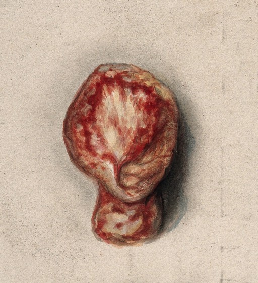 Testicle; specimen removed from man with syphilis, 1858