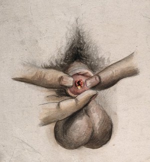 view A diseased penis. Watercolour by C. D'Alton, 1858.