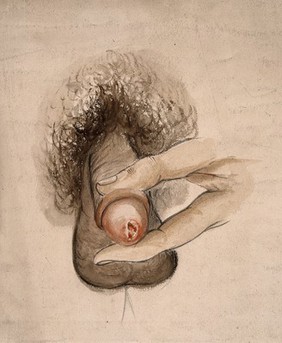 A diseased penis. Watercolour by C. D'Alton, 1858.