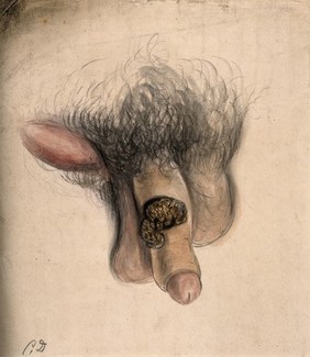 A severely diseased penis, with a swelling in the groin area. Watercolour by C. D'Alton, 1858.