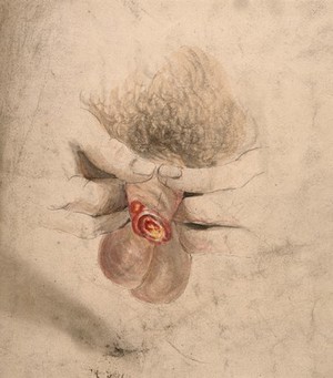 view A diseased penis. Watercolour by C. D'Alton, 1858.