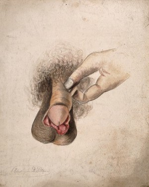 view A diseased penis. Watercolour by C. D'Alton, 18--.