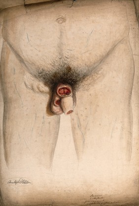 Diseased penis and scrotum with swellings or ganglions in the groin area. Watercolour by C. D'Alton, 1858.