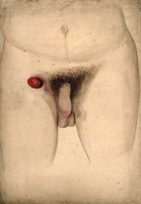 Diseased penis with a large red swelling or abcess in the groin area. Watercolour by C. D'Alton, 1857.