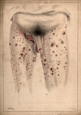 The diseased penis and legs of a man, with an open wound in the groin area. Watercolour by C. D'Alton, 1869.