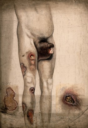 The severely diseased and swollen scrotum and legs of a man, with details showing diseased areas of skin on the leg and shoulder. Watercolour by C. D'Alton, 1840/1870?.