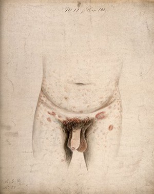 view The diseased genitals, groin, abdomen and upper legs of a man suffering from syphilis roseola. Watercolour by C. D'Alton, 18--.