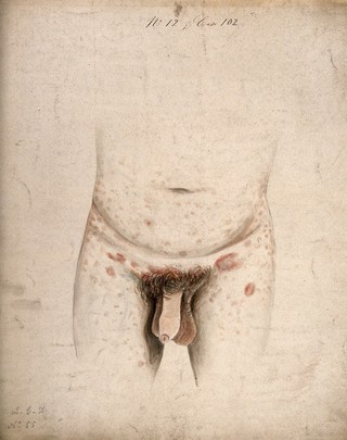 The diseased genitals, groin, abdomen and upper legs of a man suffering from syphilis roseola. Watercolour by C. D'Alton, 18--.