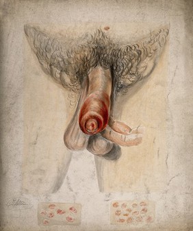 Diseased and inflamed penis with details showing areas of diseased skin on the upper arm and sternal region. Watercolour by C. D'Alton, 18--.