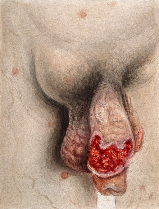 ?Syphilis, genital sore and inguinal swelling, 1875