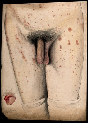 view The diseased genitals, legs and abdomen of a man, with a detail showing the penis. Watercolour by C. D'Alton, 1858.