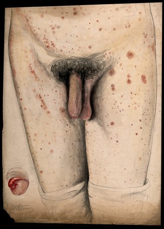 The diseased genitals, legs and abdomen of a man, with a detail showing the penis. Watercolour by C. D'Alton, 1858.